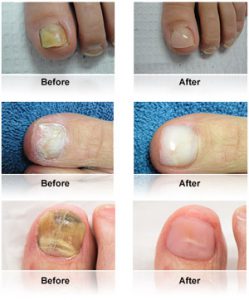 KeryFlex Nail Restoration Before & After
