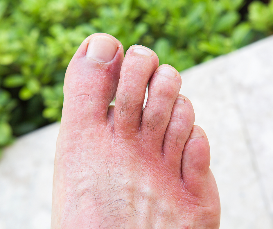 Why Are My Feet Itchy? Our Top Tips For Itchy Toes And Feet – My FootDr