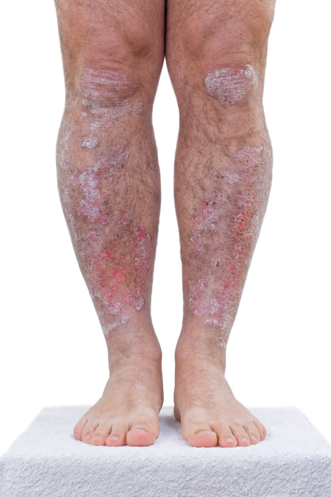 Psoriasis Causes and treatments