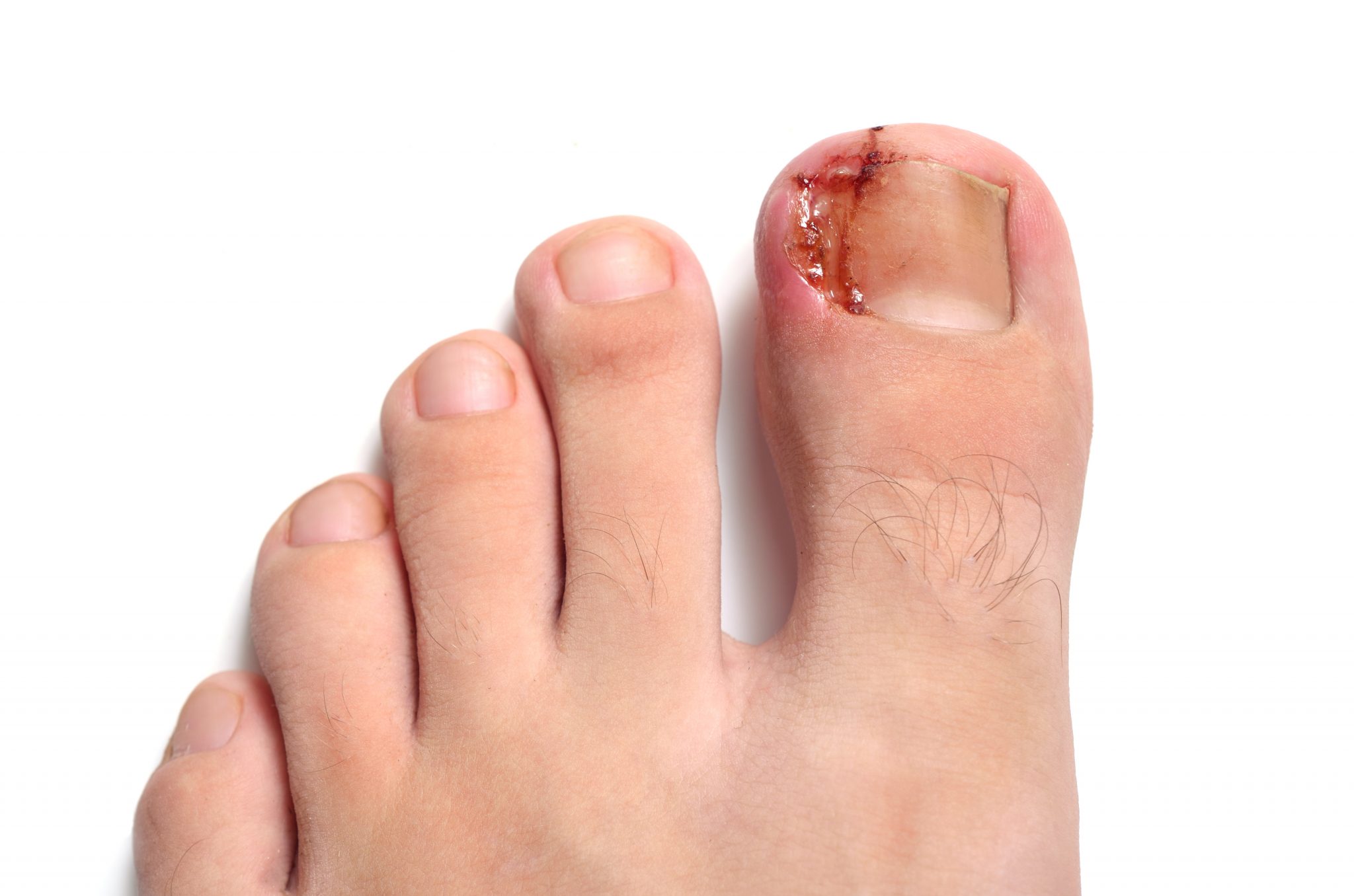 Ouch! How To Fix Ingrown Toenails Now My FootDr