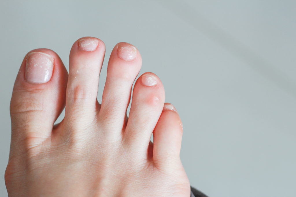 Black spot under toenail
