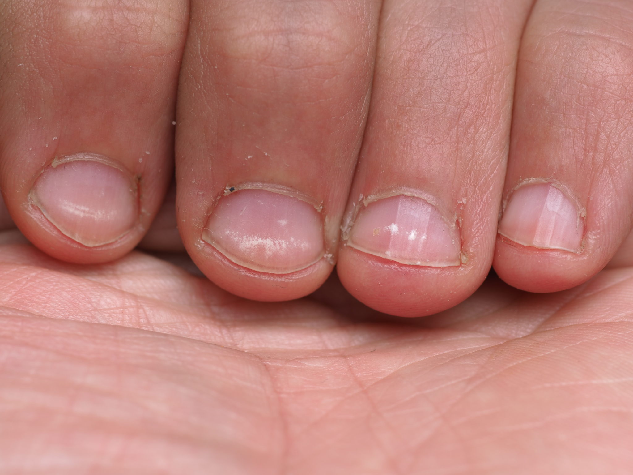 White Spots on Nails: Causes and Treatment - wide 5