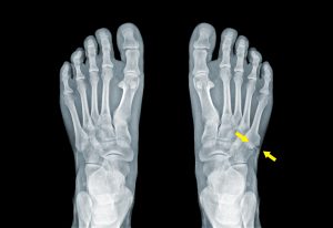 foot growth plate pain