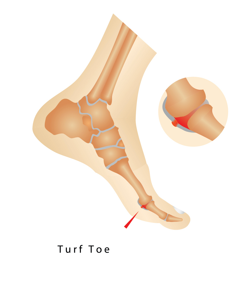 Turf Toe Causes & Symptoms