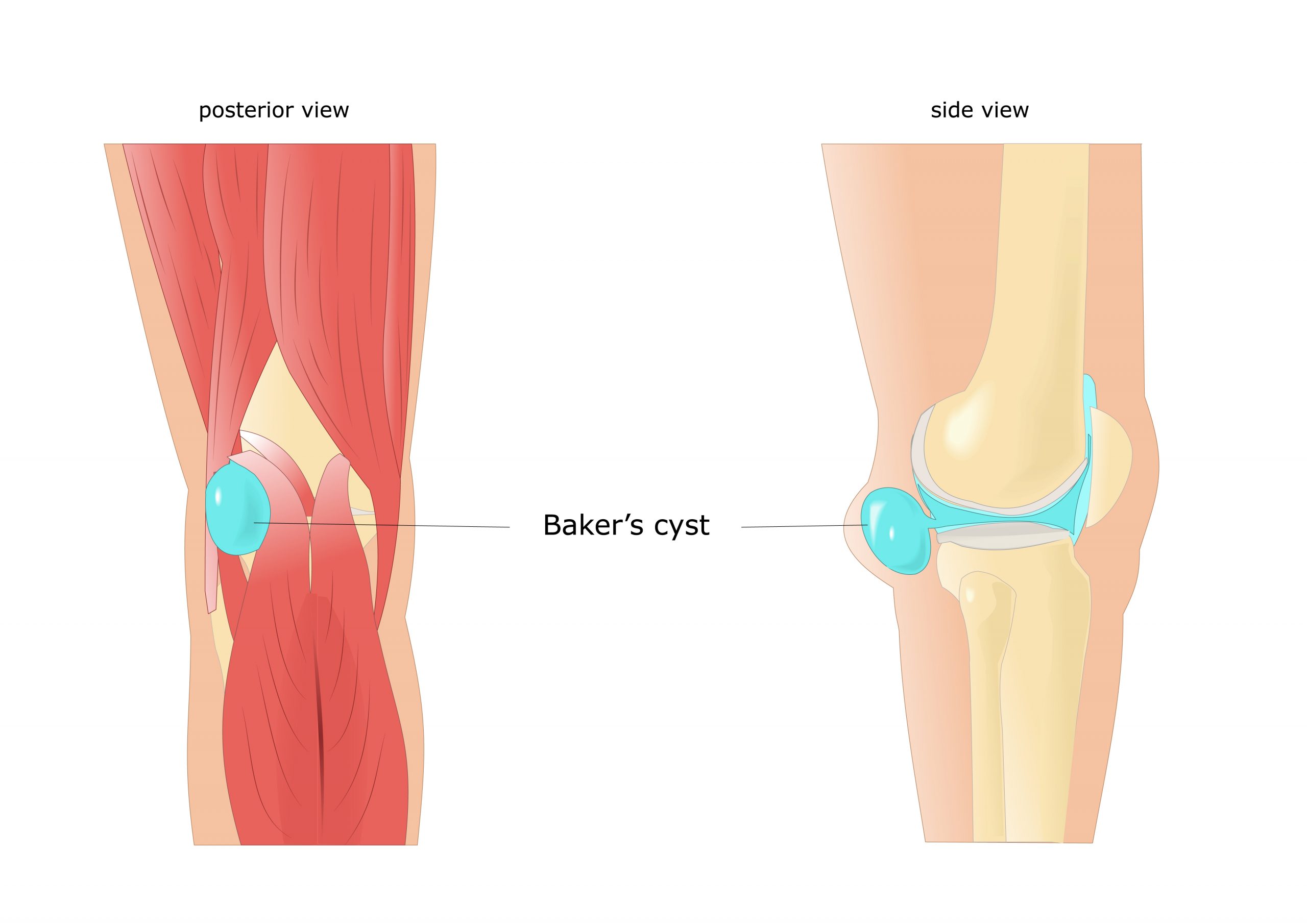 Runners Health Check: What's Causing The Lump Behind Your Knee? – My FootDr