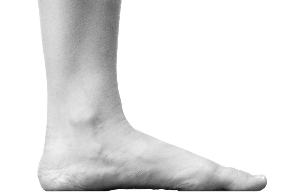 Flat Feet Treatment