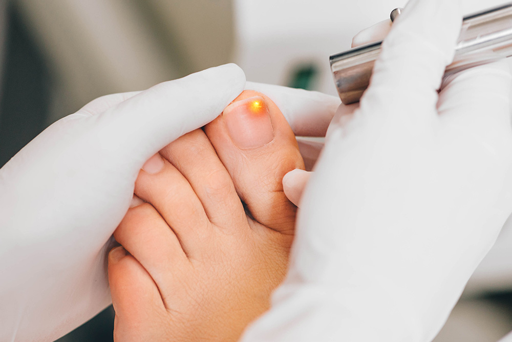 Fungal Nail Infection Laser Treatment – My FootDr