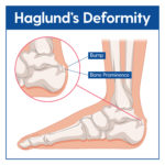 Haglund’s Deformity Causes & Treatment – My FootDr