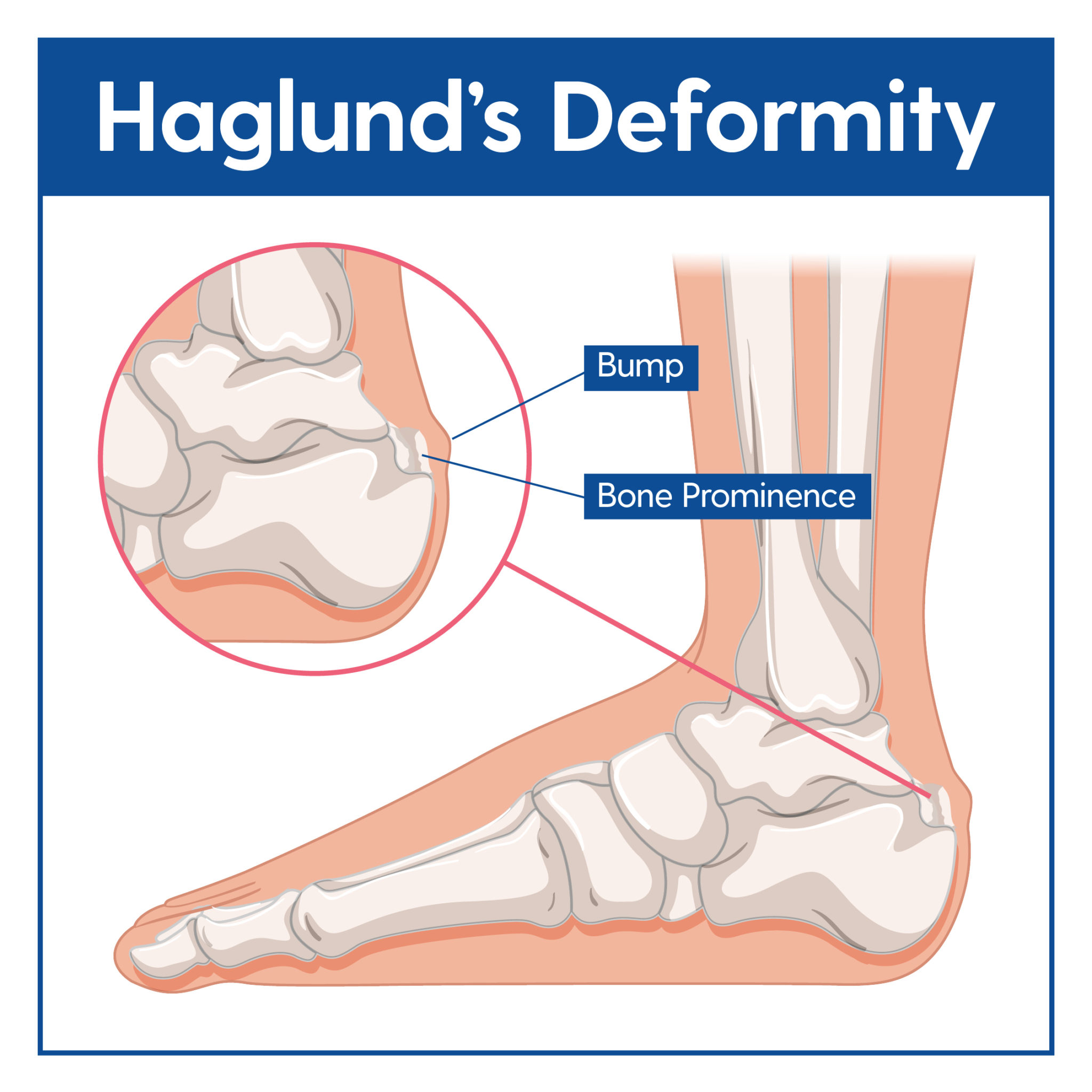 Haglund’s Deformity Causes & Treatment My FootDr