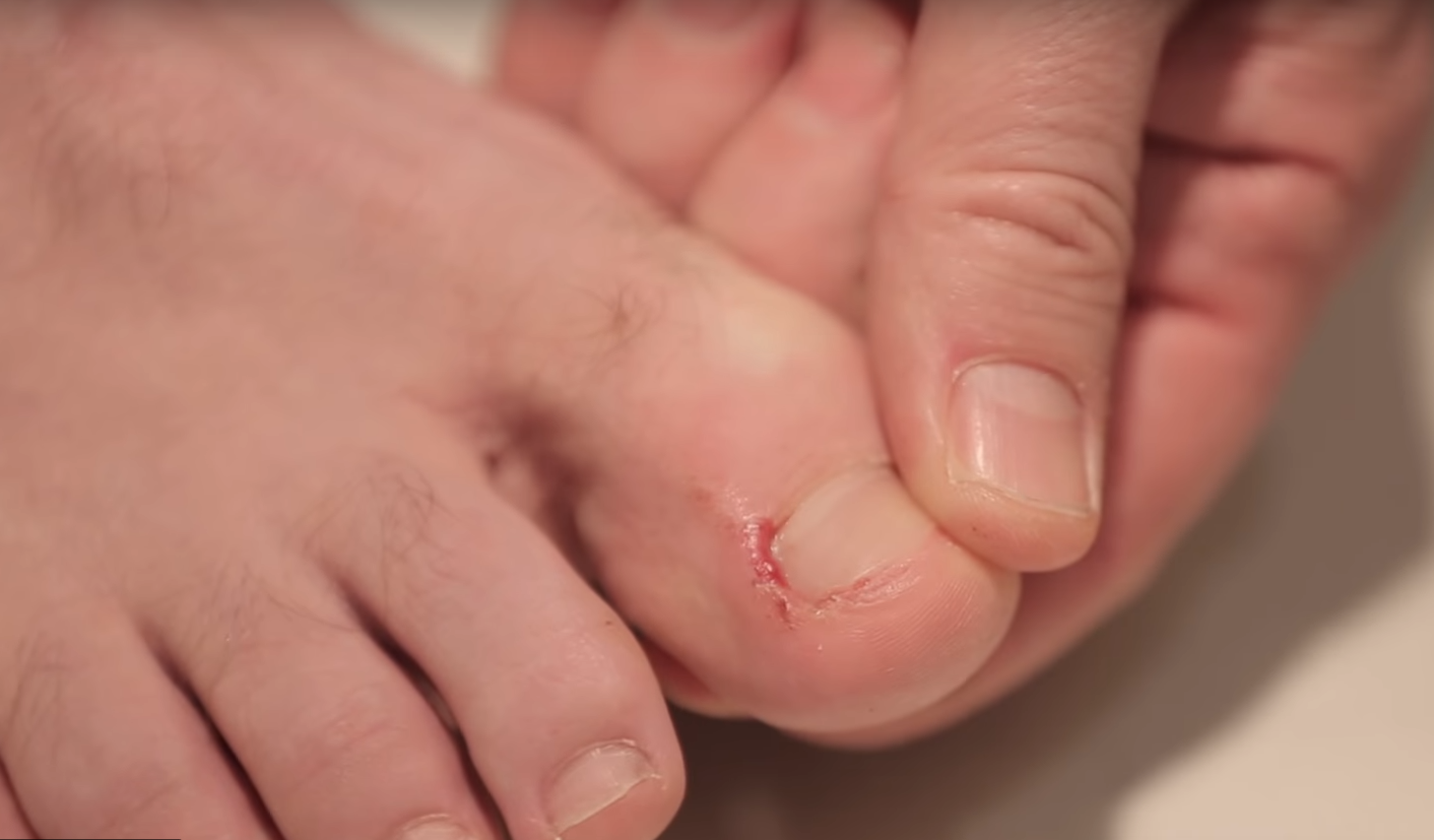 Ouch! How To Fix Ingrown Toenails Now – My FootDr