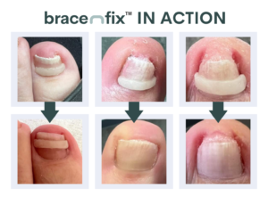 Bracenfix™ - Ingrown Toenail Treatment