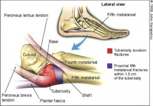 Paediatric Lateral Foot Pain islins disease