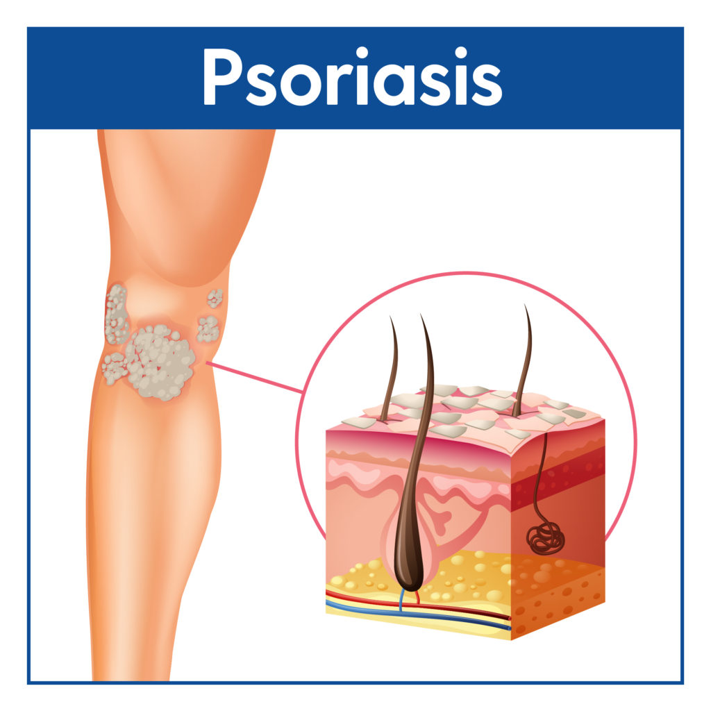 Psoriasis Psoriasis: Signs