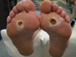 Diabetic Ulcers on Feet